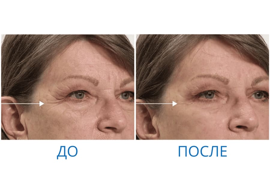 До и после: Анастасия В. 52 года. г. Ростов-на-Дону