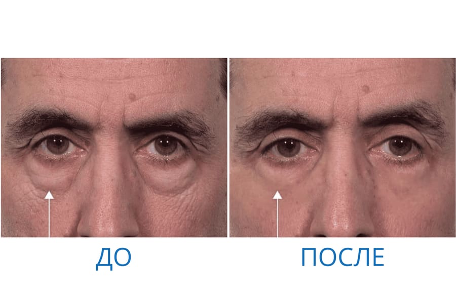 До и после: Анатолий П. 51 год. г. Иркутск