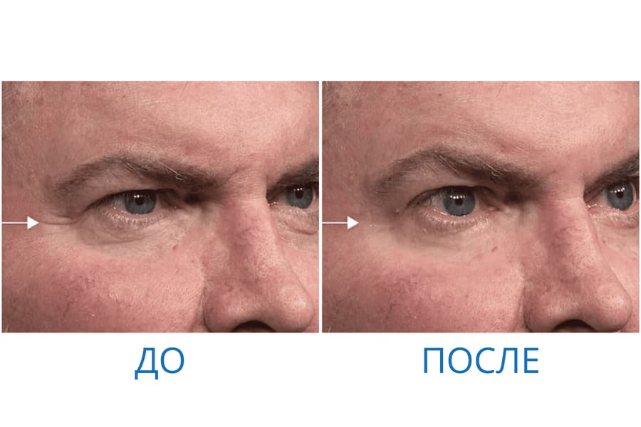 До и после: Владимир З. 56 лет. г. Ижевск