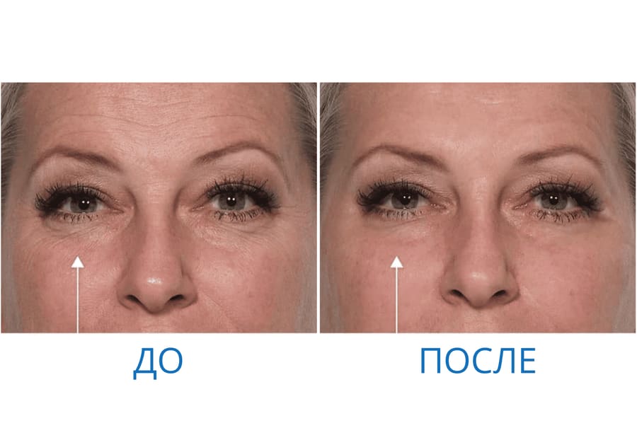 До и после: Екатерина А. 44 года. г. Москва