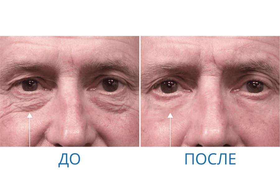 До и после: Александр М. 60 лет. г. Екатеринбург