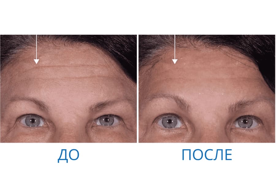 До и после: Антонина Н. 48 лет. г. Санкт-Петербург