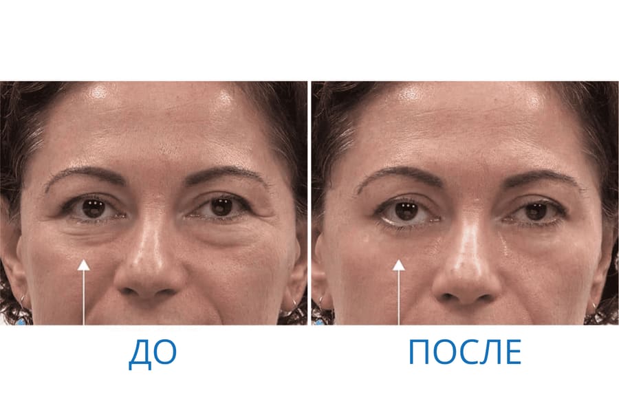До и после: Мария Д. 46 лет. г. Якутск