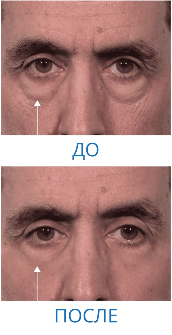 До и после: Анатолий П. 51 год. г. Иркутск